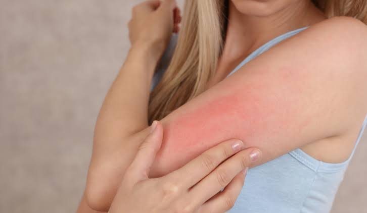 Skin Allergy Treatment 