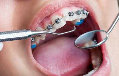 Orthodontic