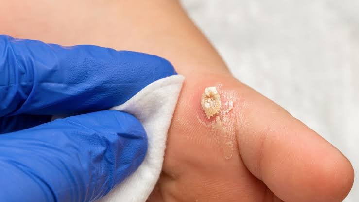 Wart Treatment 