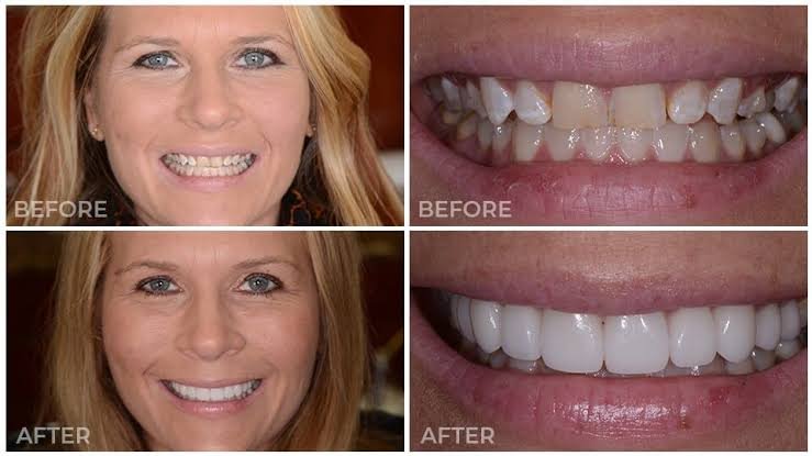 Procelain veneers