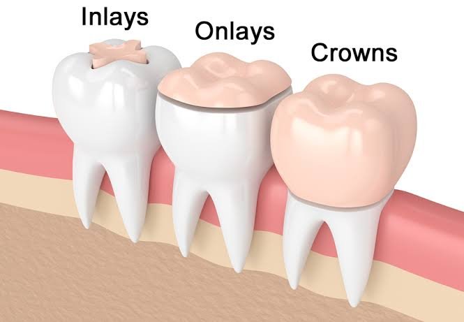 Inlays and Onlays