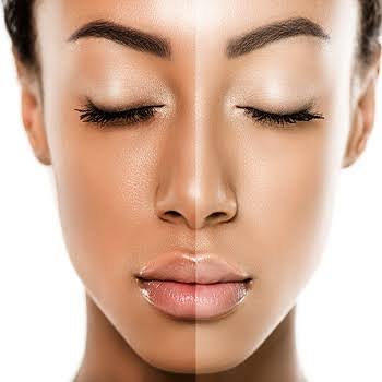 Skin Whitening 